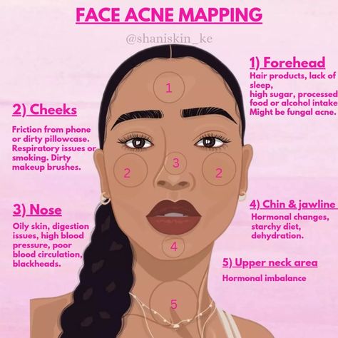 Acne On Face Meaning, Acne Mapping Face, Acne Meaning Face Mapping, Things That Help With Acne, Break Out Zones Face, Skin Problems Face, Acne On Forehead, Acne Map, Girly Skincare