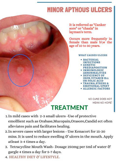 Canker Sore Causes, Med Notes, Medical Things, Nurse Things, Nurse Study, Nursing School Essential, Nursing Study Guide, Dental Hygiene School, Medicine Notes