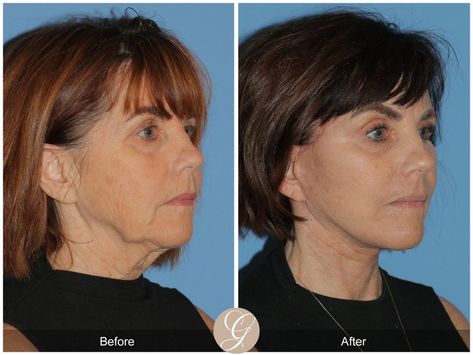 Deep Plane Facelift Before & After Photos From Dr. Kevin Sadati Deep Plane Facelift Before And After, Deep Plane Facelift, Facelift Before And After, Travel Globe, Before After Photo, Face Lift, After Photos, Plastic Surgeon, Cosmetic Surgery