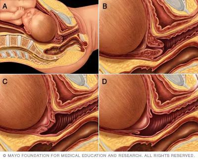 Cervical effacement and dilation - Mayo Clinic Cervical Effacement, Pregnant Anatomy, Labor Stages, Dilation And Effacement, Maternal Nursing, Midwife Assistant, Labor And Delivery Nursing, Labor Pain Management, Birth Hospital