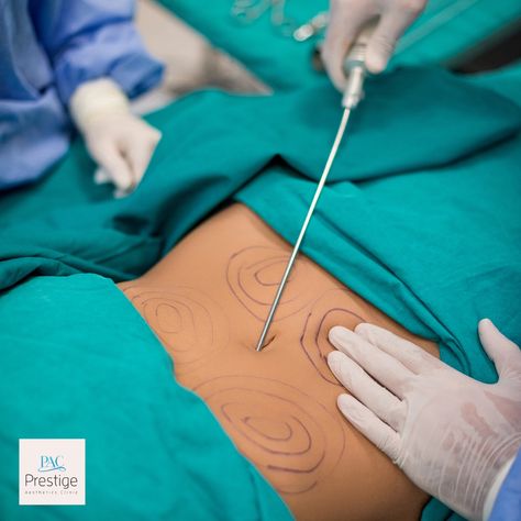 Why choose MicroAire Liposuction? ❌ No general anesthesia ❌ No surgery ☑️ Easy recovery ☑️ Results within 3 weeks Schedule a consultation with our specialist 👉 https://www.pacboca.com/liposuction #liposuction #medspa #confident #beauty #bocaraton #miznerpark #antiaging Prestige Aesthetic, Lipo Hd, Plastic Surgery Aesthetic, Body Surgery, General Anesthesia, General Anaesthesia, Board Pictures, Vision Board Pictures, Aesthetic Clinic