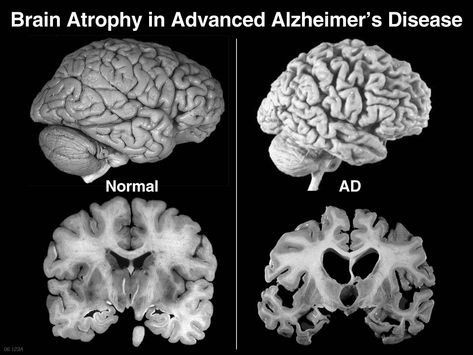 Alzheimer's The Human Brain, Healthy Brain, Human Brain, Neurology, Alzheimers, Brain Health, Neuroscience, Newport, Coconut Oil