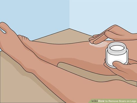 Scar Fading Remedies, Scar Removal Remedies Leg, How To Get Rid Of Scars On Legs Fast, How To Get Rid Of Scars On Legs Diy, How To Remove Scars On Legs Fast, How To Remove Scars, Leg Scars, Removing Hyperpigmentation, Dark Spots On Legs