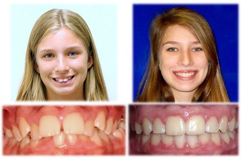 Before and after pics of patient treated for overbite...you can see the extreme change in her profile... Overbite Before And After, Before And After Pics, Before And After Pictures, Change In, Nursing School, Braces, Nursing, Quick Saves