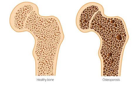 Bone Density Test, Osteoporosis Exercises, Whole Body Vibration, Bone Fracture, Calcium Rich Foods, Bone Diseases, Diet Doctor, Bone Loss, Bone Density