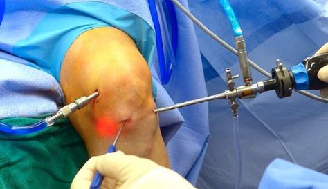 #arthroscopy is a surgical procedure orthopaedics use to look at, diagnose, and treat problems inside a joint. Dr. Ashu Consul may recommend it if you have inflammation in a joint, have injured a joint, or have damaged a joint over time. Call: 9871442963 Visit: www.theneoorthopaedicclinic.com www.theneoorthopaedicclinic.com/arthroscopic-surgery/ www.theneoorthopaedicclinic.com/partial-knee-replacement/ #orthopedicindelhi #arthroscopyindelhi Arthroscopic Knee Surgery, Ligament Injury, Knee Surgery, Dental Instruments, Knee Replacement, Medical Tourism, Surgical Instruments, Knee Pain, Surgery