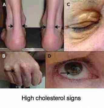 High Cholesterol Symptoms, Foods To Reduce Cholesterol, Ways To Lower Cholesterol, What Causes High Cholesterol, Cholesterol Symptoms, Cholesterol Test, Cholesterol Foods, High Cholesterol Levels, Cholesterol Remedies