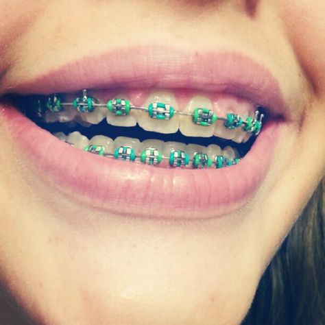 Mint and green + .*・。 Braces Colors Combinations, Braces Color Wheel, Braces Retainer, Green Braces, Braces Smile, Cute Braces Colors, Braces Cost, Braces Tips, Getting Braces