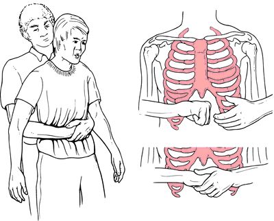 Conscious choking- Heimlich Maneuver Acute Respiratory Failure, Emt Study, Heimlich Maneuver, Medical Dictionary, First Aid Tips, First Aid Course, Medical School Life, Basic Anatomy And Physiology, Medical Surgical Nursing