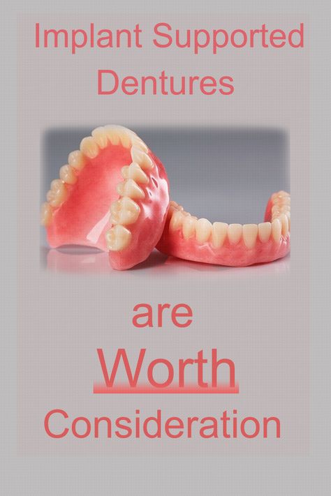 implant-supported dentures Snap In Dentures Implants, Teeth Care Routine, Teeth Pain Relief, Gums Receding, Aesthetic Teeth, Affordable Dental Implants, Wisdom Tooth Extraction, Denture Implants, Dental Tips