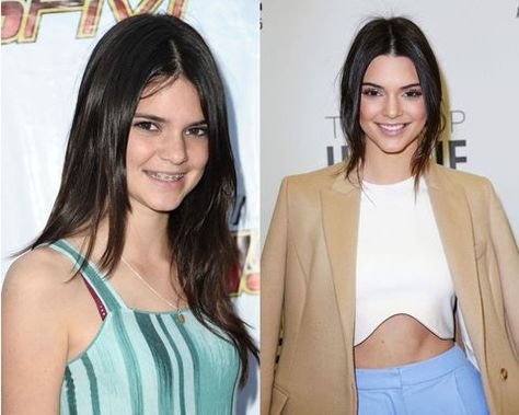 12 Celebs With Braces That Prove It Gets Better Kendall Jenner Braces, Celebrities With Braces, Kendall Jenner Boyfriend, Amelia Gray Hamlin, Invisible Braces, Brace Face, Best Profile, Dental Braces, Straight Teeth