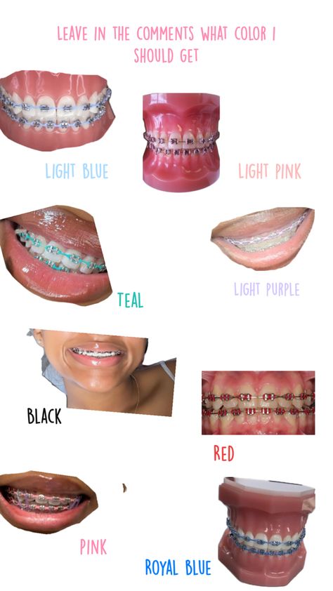 Dental Braces Colors, Braces Colors Combinations, Cute Braces Colors, Pretty Teeth, Braces Tips, Getting Braces, Braces Girls, Cute Braces, Brace Face