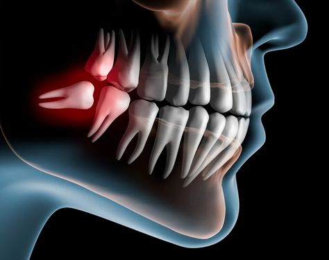 A diagram of a Impacted wisdom teeth Impacted Wisdom Teeth, Impacted Tooth, Cracked Tooth, Wisdom Tooth Extraction, Remedies For Tooth Ache, Bone Grafting, Dental Photography, Wisdom Teeth Removal, Tooth Removal