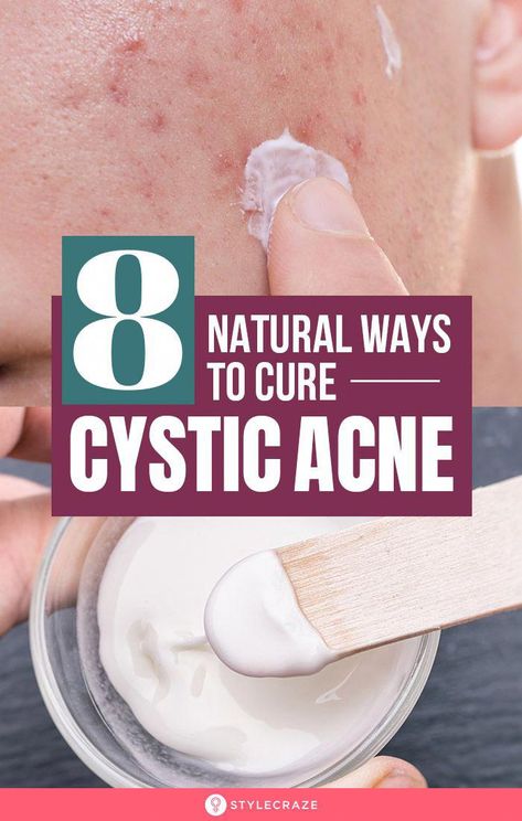 #TongueScraper Cystic Acne On Chin, Treating Cystic Acne, Chin Acne, Cystic Acne Remedies, Natural Antifungal, Cystic Pimple, Acne Overnight, Nail Fungus Remedy, Acne Vulgaris