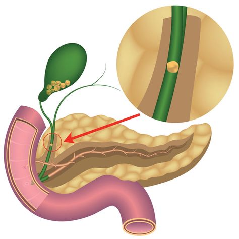 𝗚𝗮𝗹𝗹𝗯𝗹𝗮𝗱𝗱𝗲𝗿 𝘀𝘁𝗼𝗻𝗲𝘀 𝘀𝘆𝗺𝗽𝘁𝗼𝗺𝘀 Discomfort or pain in the right upper abdomen Pain radiating to the right shoulder or the back Nausea or vomiting Heartburn, gas, indigestion Frequent digestion issues Yellow skin or eyes Dark urine Fevers and chills For More Information 098930 74467 https://www.shantirajhospital.com/about-gallbladder-stones/#Gallbladder_stones_symptoms Gallbladder Stones, Yellow Skin, Eyes Dark, Skin, Health, Stone, Yellow