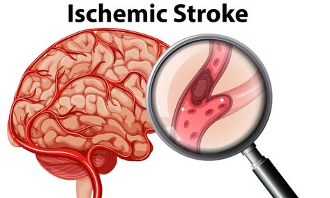 Cerebral infarction, also called ischemic stroke, refers to an area of necrotic tissue in the brain caused by disrupted ... Types Of Strokes, Brain Surgeon, Loss Of Balance, Low Estrogen, 8th Sign, High Blood Sugar, Easy Vegetarian, Warning Signs, Types Of Food