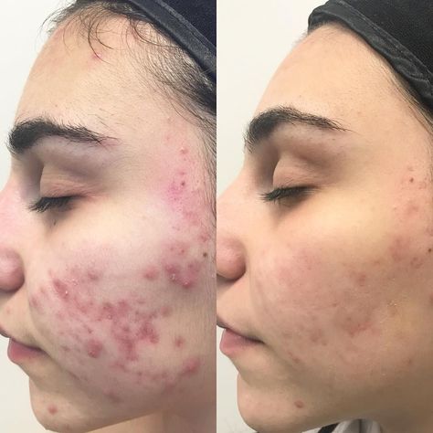 This before and after results are four months apart and was achieved using DMK products by Euphoria Skin Hydrafacial Before And After, Facial Machines, Facial Before And After, Before And After Acne, Skin Care Pictures, Acne Face, Butterfly Printable, Face Acne, Chemical Peel