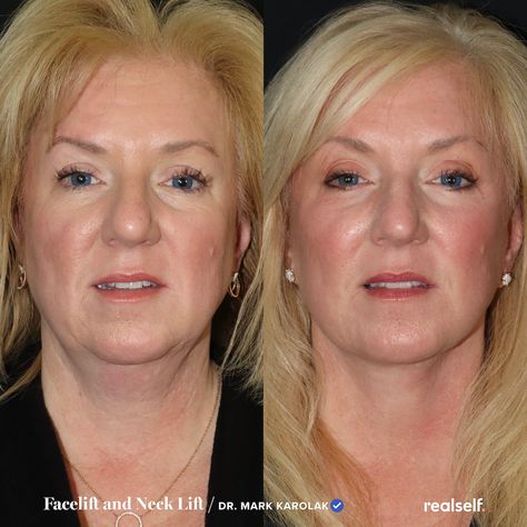 Plastic surgeons share five facelift recovery concerns, some of them common and treatable and others more under-the-radar. Facelift Recovery, Facelift Surgery, Facelift Before And After, Facelift Procedure, Face Lift Surgery, Plastic Surgery Procedures, Excess Skin, Under The Knife, Facial Rejuvenation