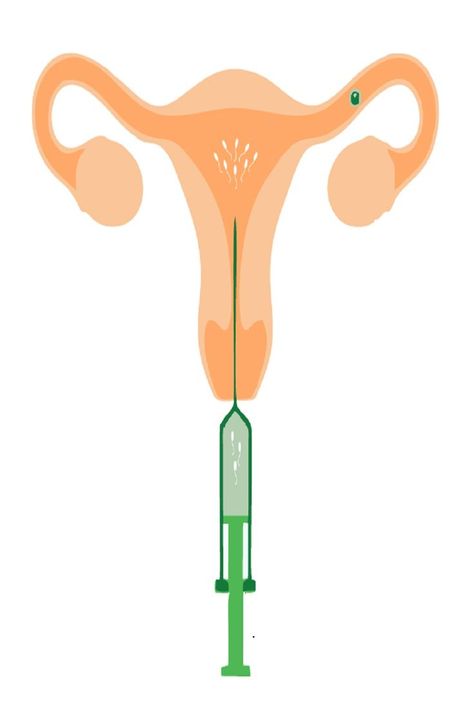 IUI Treatments Iui Procedure, Blocked Fallopian Tubes, Cervical Mucus, Sperm Donor, Ivf Center, Fallopian Tubes, Body Condition, Success Rate, Ahmedabad