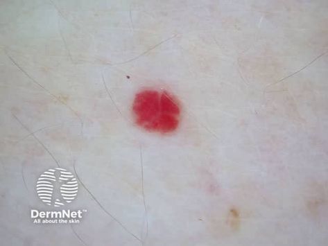 DermNet® - Cherry Angioma: Features, Causes, and Removal — DermNet Cherry Angioma, Next Generation Sequencing, Basal Cell, Med Surg, Skin Spots, Skin Diseases, Sponsored Content, Blood Vessels, The Body