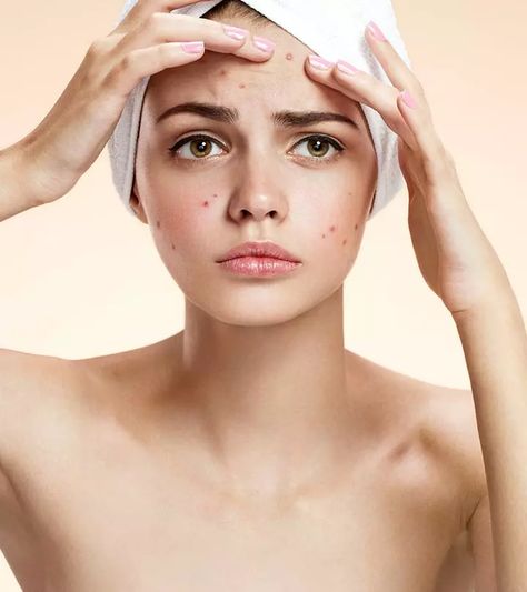 19 Best Home Remedies To Get Rid Of Blemishes On Face Remove Pimples, Natural Acne Remedies, How To Get Rid Of Pimples, How To Remove Pimples, Skin Blemishes, Acne Remedies, Unwanted Hair Removal, How To Get Rid Of Acne, Unwanted Hair