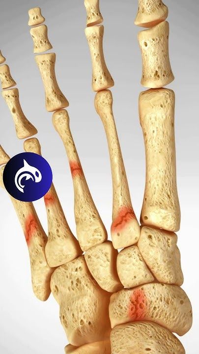 🚨 Stress Fracture of the Foot 🚨 

Foot stress fractures are common, especially among athletes and runners, accounting for 20% of sports-related injuries. These tiny cracks in the bone often result from overuse and can take 6-8 weeks to heal with proper rest and care. 

YouTube: Soccer Injuries, Foot Anatomy, The Bone, 3d Animation, Anatomy, Accounting, Soccer, Football