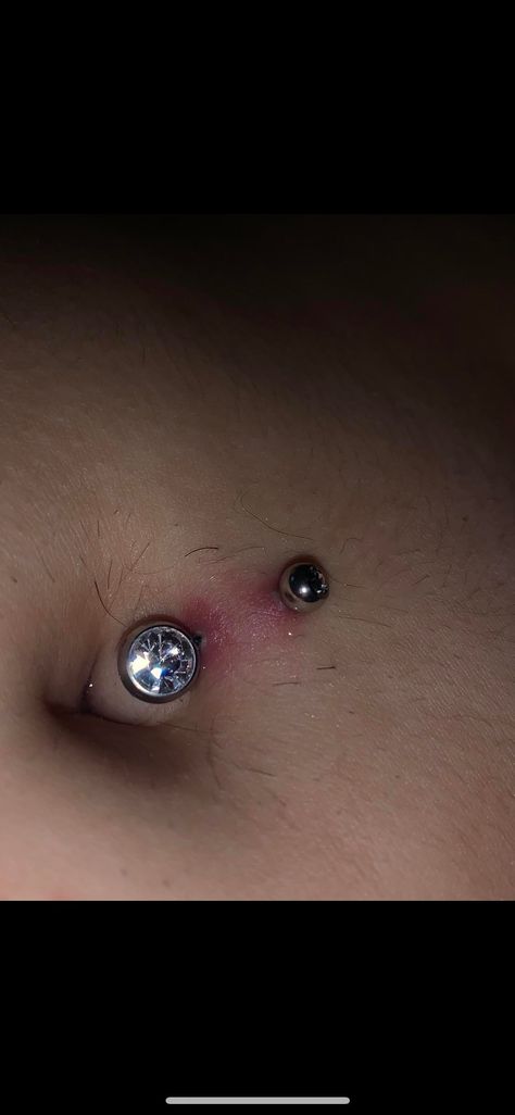 Belly button piercing after 2 weeks.. But unsanitary conditions and poor aftercare are the leading causes of bacterial infections after piercings.. Skin discoloration if the infection goes to a more advanced stage;. Mine is 6 months old and has been doing the same thing since 2 months, i feel google is misleading, i know people who have purple discoloration permanently on their.You can look new details of Belly Piercing Discoloration by click this link : view details Red Streaks, Scar Cream, Button Piercing, Organ Transplant, Bacterial Infection, Belly Piercing, Belly Button Piercing, Skin Discoloration, Ear Piercing