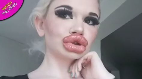 The world's biggest lips... Hyaluronic Acid Lips, Barbie Images, Lip Injections, Weird News, Lip Fillers, Feeling Happy, How To Look Pretty, Instagram Followers, Barbie Dolls