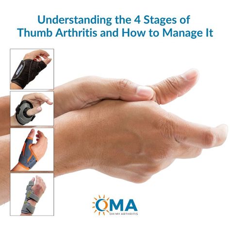 Thumb arthritis affects millions of people worldwide, causing pain, stiffness, and limited mobility in the thumb joints. By understanding the four stages of thumb arthritis, you can take action to prevent further damage and find relief. Read on to learn more Thumb Pain Relief, Hand Therapy Exercises, Thumb Brace, Thumb Splint, Trigger Finger, Hand Therapy, Carpal Tunnel, Take Action, The Four