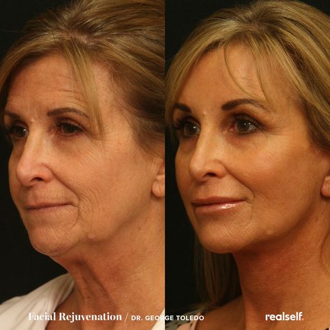 Facial Fat Grafting, Neck Tightening Procedures, Fat Grafting Face, Face Lift, Neck Lift Surgery, Face Plastic Surgery, Mini Face Lift, Facial Procedure, Skin Tightening Treatments