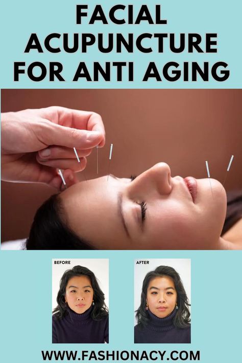 Facial Acupuncture For Anti Aging, Before & After Facial Acupuncture, Homemade Beauty Tips, Best Beauty Tips, Romantic Evening, Flawless Makeup, Summer Beauty, Holistic Approach, Flawless Skin, Reduce Wrinkles