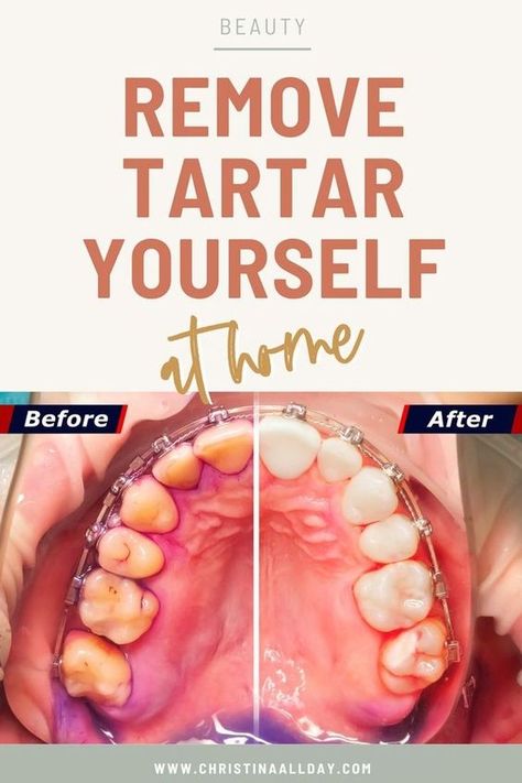 Tartar Removal, Plaque Removal, Teeth Health, Gum Care, Oral Care Routine, Receding Gums, The Dentist, Natural Teeth Whitening, Teeth Care