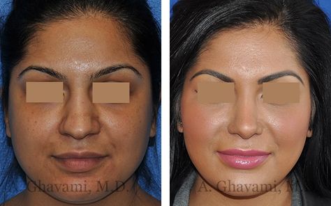 Nostril Reduction, Ethnic Rhinoplasty, Rhinoplasty Before And After, Rhinoplasty Surgery, Perfect Brow, Reduction Surgery, Perfect Nose, Nose Job, Perfect Brows