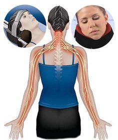 Pinched Nerve In Neck, Neck Pain Exercises, Numbness In Hands, Cervical Disc, Neck Traction, Cervical Spondylosis, Pinched Nerve, Neck Exercises, Nerve Pain Relief