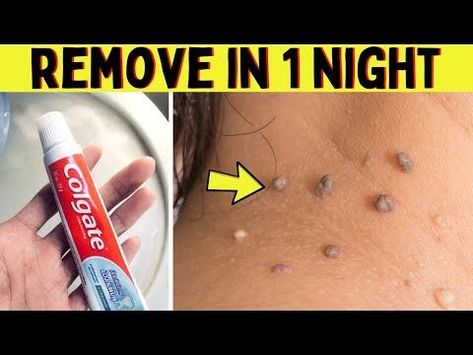 Natural Remedies For Skin Tags, Remove Moles And Skin Tags, Diy Removal Of Skin Tags, Home Remedy For Skin Tags, Warts Removal On Face, Diy Remove Skin Tags At Home, Best Way To Remove Skin Tags, Skin Mole Removal At Home, Get Rid Of Skin Tags Fast