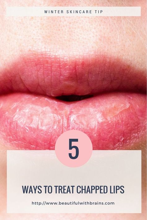 how to treat chapped lips #chappedlips #winterskincare #skincaretips Lips Remedies, Chapped Lips Remedy, Ways To Heal, Skincare Habits, Winter Lips, Winter Skin Care, Peeling Skin, Anti Aging Tips, How To Get Rid Of Acne