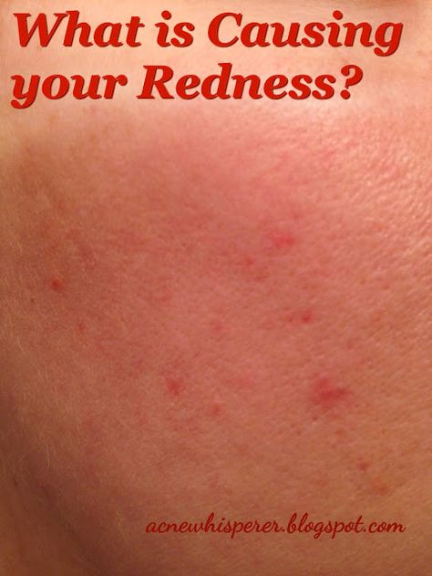 Adult Acne? Allergic Reaction? Rosacea?  Reaction to a Product? Red Rash On Face, Red Spots On Face, Reduce Face Redness, Red Blotchy Skin, Redness On Face, Acne Help, Face Tips, Holistic Health Remedies, Anti Redness