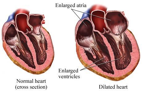 Enlarged Heart Symptoms, Enlarged Heart, Heart Valves, Normal Heart, Gene Therapy, Heart Health, Heart Healthy, Herbal Remedies, Organic Skin Care