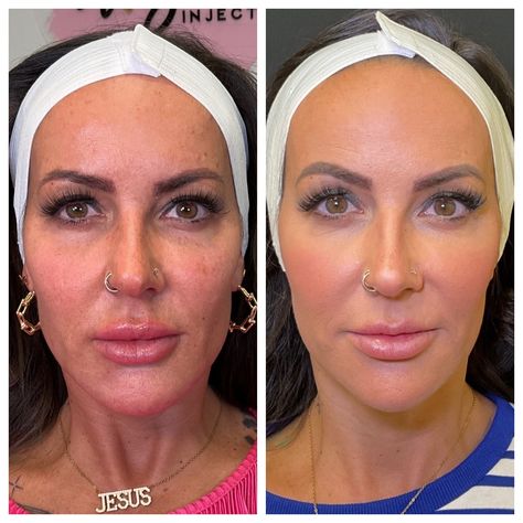 𝙏𝙝𝙖𝙩 𝙜𝙡𝙤𝙬! 🌟 We've loved watching this transformation! The goal was a more refreshed and feminine look and I think we've found it! 🥰 What we've done over the last 7 months: • Dissolved filler in her chin, jawline, and lips • 3 Morpheus face/neck treatments • 3 PRX DermPerfexion skin treatments • 3 vials of Sculptra • 6 PDO threads to the lower face • Masseter Botox Kelci Hunter, NP | @the.arizona.injector 📍 @vidabellamedspa | Glendale, AZ 💻 www.vidabellamedspa.com 📱(623) 277-7761 👩‍💻 Boo... Chin Injection Before And After, Cheekbone Filler Before And After, Jaw And Chin Filler, Two Faces Lip Injection, Chin Filler Injection, Youthful Skin, Feminine Look, Skin Treatments, Wrinkles