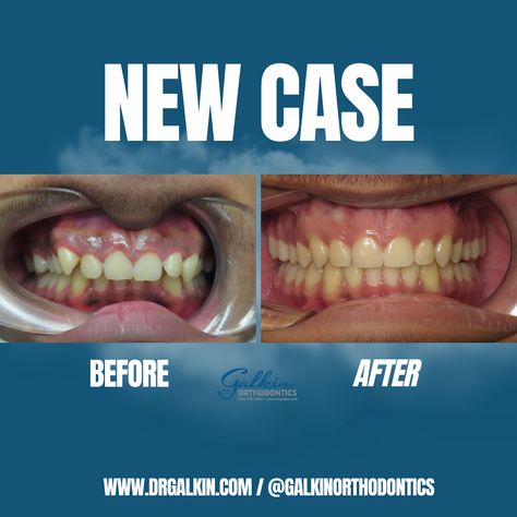 Check out this before and after Invisalign and overbite correction! Ready to start your own Invisalign journey? 

☎️ 732-636-2828
.
.
#galkinorthodontics #smiletransformation #invisalign #greatsmilesbygalkin Before And After Invisalign, Overbite Correction, To Start, Quick Saves