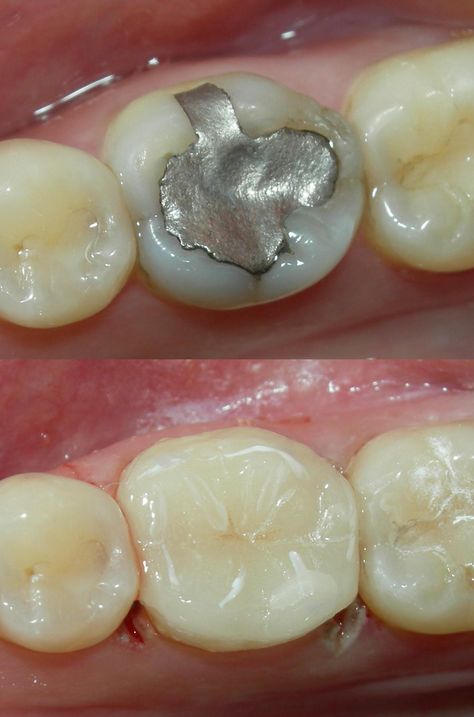 Before & After: Large silver filling replaced by white, composite filling. The filling looks so natural it is almost unnoticeable! Filling Teeth, Composite Fillings, Dental Cement, Dental Images, Dental Photography, Dental Fillings, Aesthetic Dentistry, Porcelain Veneers, Dental Cosmetics