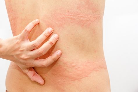 Urticaria and Fibromyalgia - Redorbit Hives Causes, Chronic Hives, Chronic Fatigue Symptoms, Home Remedies For Skin, Skin Condition, Autoimmune Disorder, Itchy Skin, Chronic Fatigue, Ayurveda