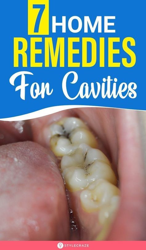 Home Remedies For Cavities, Cavity Remedy, Fix Teeth, Teeth Remedies, Reverse Cavities, Tooth Decay Remedies, Heal Cavities, Dental Cavities, Teeth Health