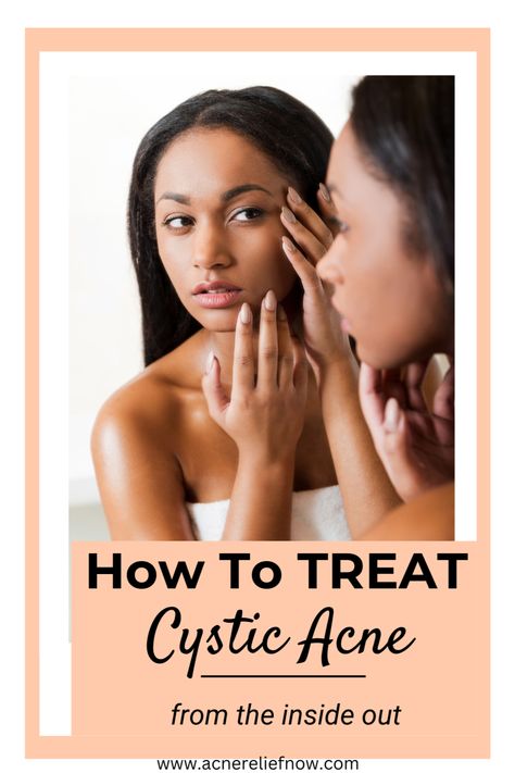 Natural ways to treat hormonal acne. How to manage hormonal acne. Learn what causes hormonal acne, ways to treat hormonal acne at home, hormonal acne tips, hormonal acne diet plan and treating hormonal acne naturally. Click the pin to get rid of hormonal acne for good. Acne Prone Skin Care Products, Skincare Acne Prone Skin, Get Rid Of Hormonal Acne, Treat Hormonal Acne, Acne Diet Plan, Skincare Routine Natural, Treatments For Acne, Hormonal Acne Diet, Comedonal Acne