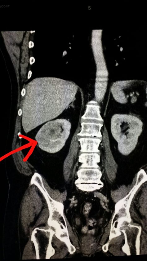 #Multidetector #CT of the #abdomen shows a #tumor (#renal #cell #carcinoma) of the #kidney. #radiologist #radiology Renal Cell Carcinoma, Computed Tomography, Pet Ct, Kidney Pain, Pet Scan, Baby Feeding Schedule, Diagnostic Imaging, Medical Imaging, Ct Scan