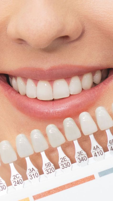 Discover the Expert Secret of Whitening Your Teeth. Read this Article Teeth Whiting At Home, Baby Tooth Decay, Dental Photos, Dental Cavities, Whiten Your Teeth, Botox Fillers, Teeth Health, Tooth Sensitivity, Gum Care