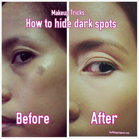 Makeup Tricks: How To Conceal Dark Spots with Makeup Conceal Dark Spots, Moles On Face, Pimples On Forehead, Age Spots On Face, Daily Beauty Tips, Acne Dark Spots, Dark Spots On Face, Brown Spots On Face, How To Apply Concealer