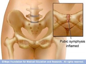 General Pubic Symphysis Dysfunction: The pubic symphysis is a very stiff, synovial joint that exists midline of the pelvis. It moves on average, about 2 mm but becomes dysfunctional if it moves more or less. The cause for pubic symphysis dysfunction can be attributed to hormonal changes, lengthening and weakening of pelvic ligaments, thoracolumbar fascia … Medical Assistant Student, Pelvic Girdle, Pelvic Bone, Psoas Muscle, Mom Bod, Fit Mama, Sciatica Pain, Joints Pain Relief, Pelvic Pain