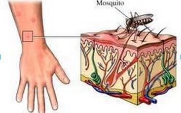 Skeeter Syndrome Mosquito Bite Allergy, Mosquito Bite Itch, Remedies For Mosquito Bites, Bug Bites Remedies, West Nile Virus, Mosquito Bites, Mosquito Bite, Bug Bites, Homemade Remedies