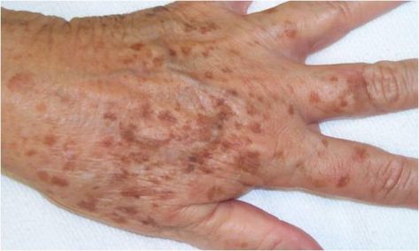 Liver spots appearing on the hand Prednisone Side Effects, Remove Age Spots, Liver Spot, Get Rid Of Spots, Age Spots On Face, Brown Age Spots, Age Spot Removal, Intense Pulsed Light, Bleaching Cream